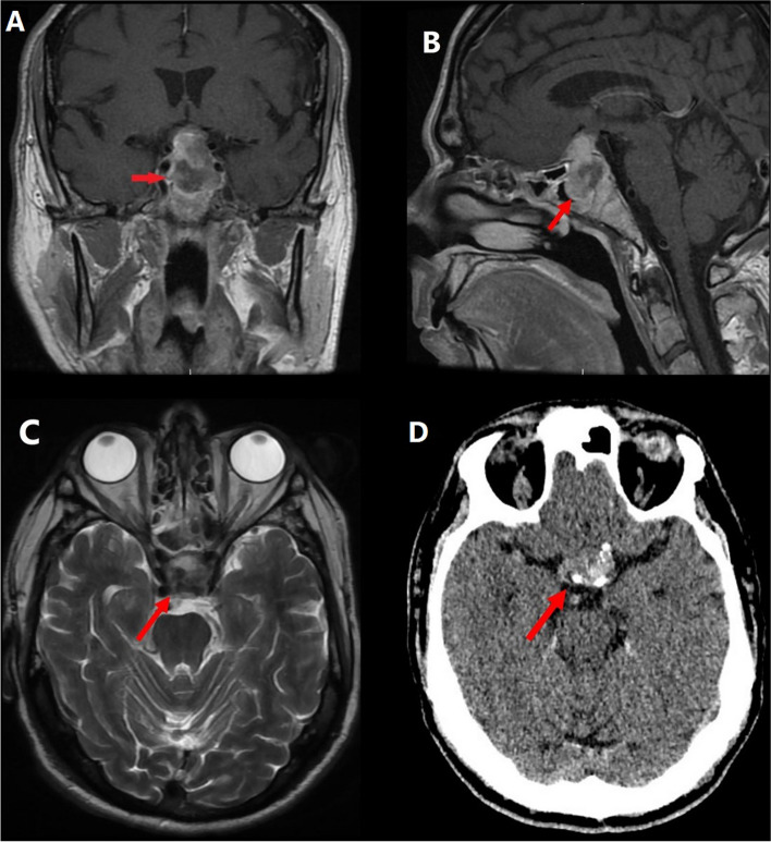 Pituitary macroadenoma apoplexy as a rare complication of Bruton tyrosine kinase inhibitor in chronic lymphoid leukaemia.