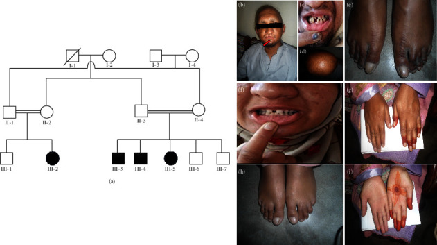 A Recurrent Nonsense Mutation in NECTIN4 Underlying Ectodermal Dysplasia-Syndactyly Syndrome with a Novel Phenotype in a Consanguineous Kashmiri Family.