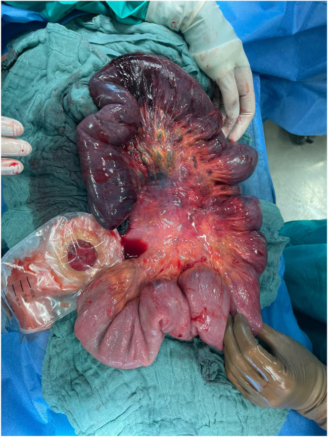 Postoperative intussusception: a rare but critical complication in adult patients with Crohn's disease - case report and literature review.