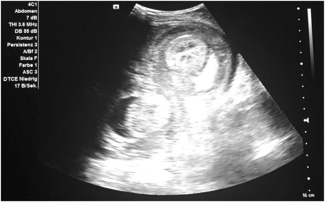 Postoperative intussusception: a rare but critical complication in adult patients with Crohn's disease - case report and literature review.