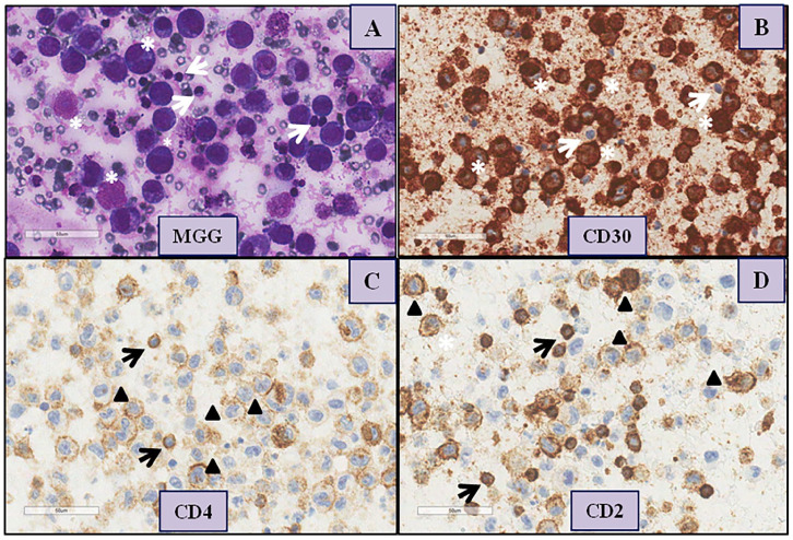 Breast implant associated anaplastic large cell lymphoma: Evidence for an efficient diagnostic workup.