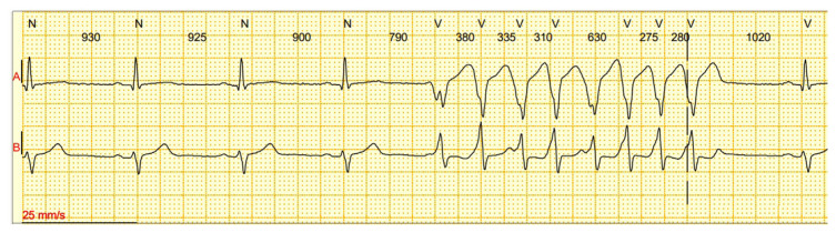 Recognizing a "Hot Phase" of An Arrhythmogenic Left Ventricular Cardiomyopathy: A Case Report.