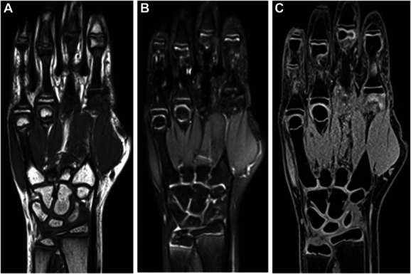 Value of Magnetic Resonance Imaging for Skeletal Bone Age Assessment in Healthy Male Children.