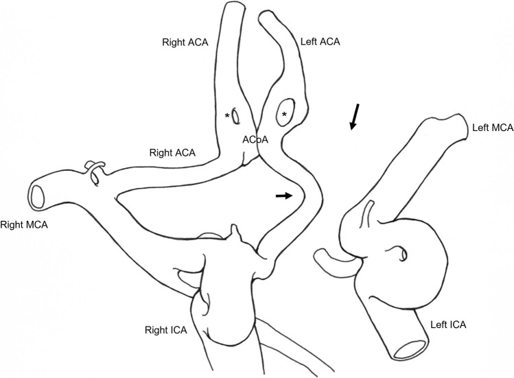 Left anterior cerebral artery arising from a right internal carotid artery: a rare case of carotid-anterior cerebral artery anastomosis.