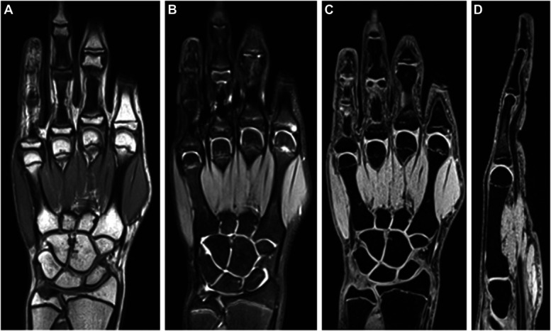 Value of Magnetic Resonance Imaging for Skeletal Bone Age Assessment in Healthy Male Children.