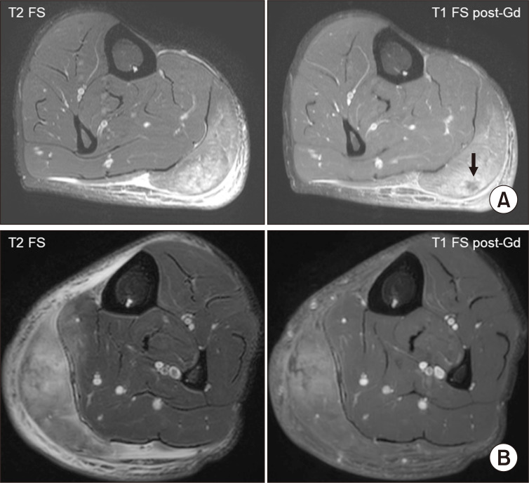 Recurrent focal myofasciitis of Behçet syndrome mimics infectious myofasciitis: a case report.