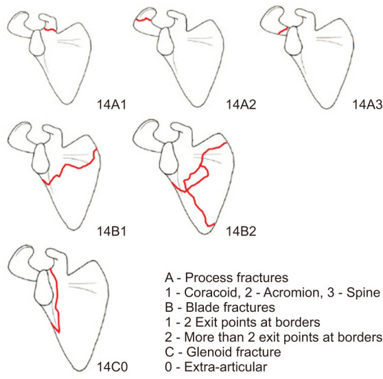 Management of Extra-articular Scapular Fractures: A Narrative Review and Proposal of a Treatment Algorithm.