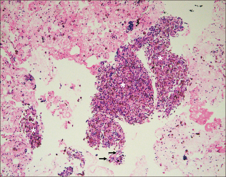 Recurrent focal myofasciitis of Behçet syndrome mimics infectious myofasciitis: a case report.