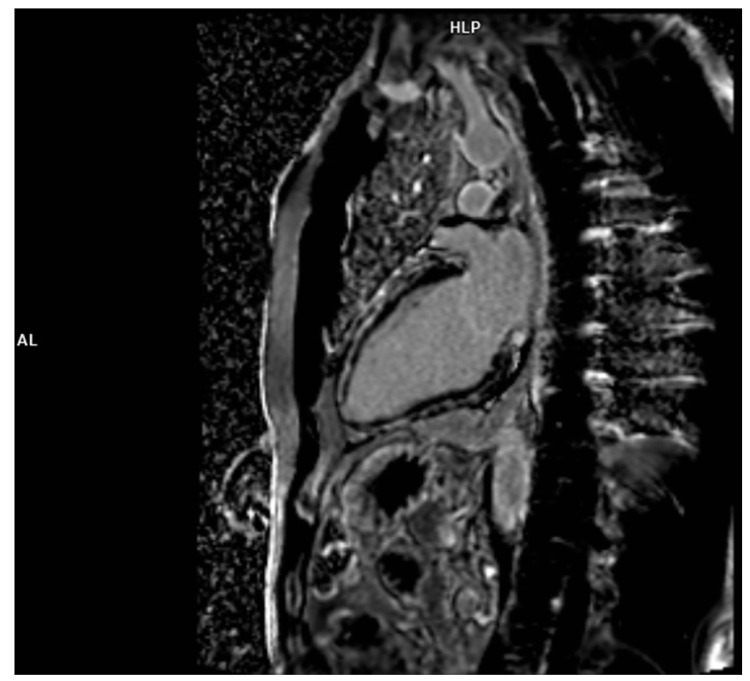 Recognizing a "Hot Phase" of An Arrhythmogenic Left Ventricular Cardiomyopathy: A Case Report.