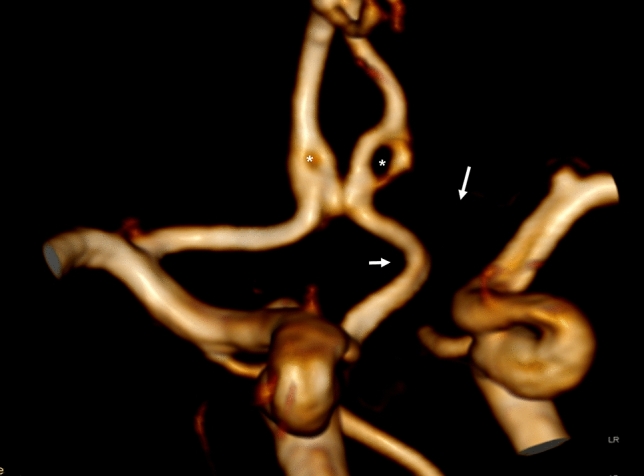 Left anterior cerebral artery arising from a right internal carotid artery: a rare case of carotid-anterior cerebral artery anastomosis.