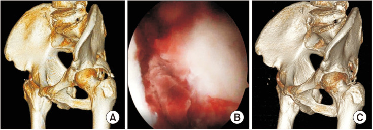 Arthroscopic Reduction and Internal Fixation in Patients with Acetabular Posterior Wall Fractures.