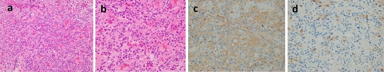 Intraventricular central neurocytoma molecularly defined as extraventricular neurocytoma: a case representing the discrepancy between clinicopathological and molecular classifications.