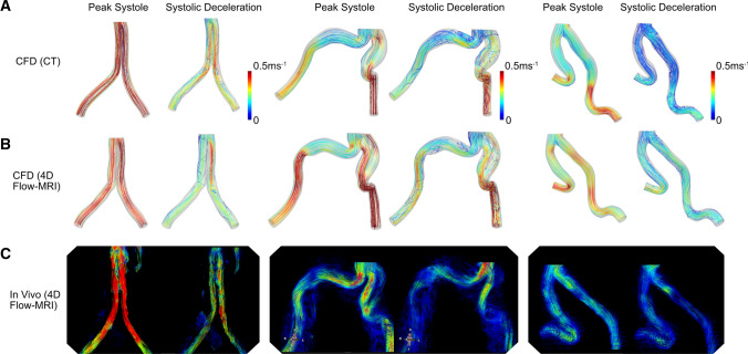 Reconstruction and Validation of Arterial Geometries for Computational Fluid Dynamics Using Multiple Temporal Frames of 4D Flow-MRI Magnitude Images.