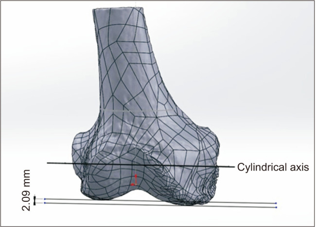 Accuracy of Patient-Specific Instrument for Cylindrical Axis Implementation in Kinematically Aligned Total Knee Arthroplasty.