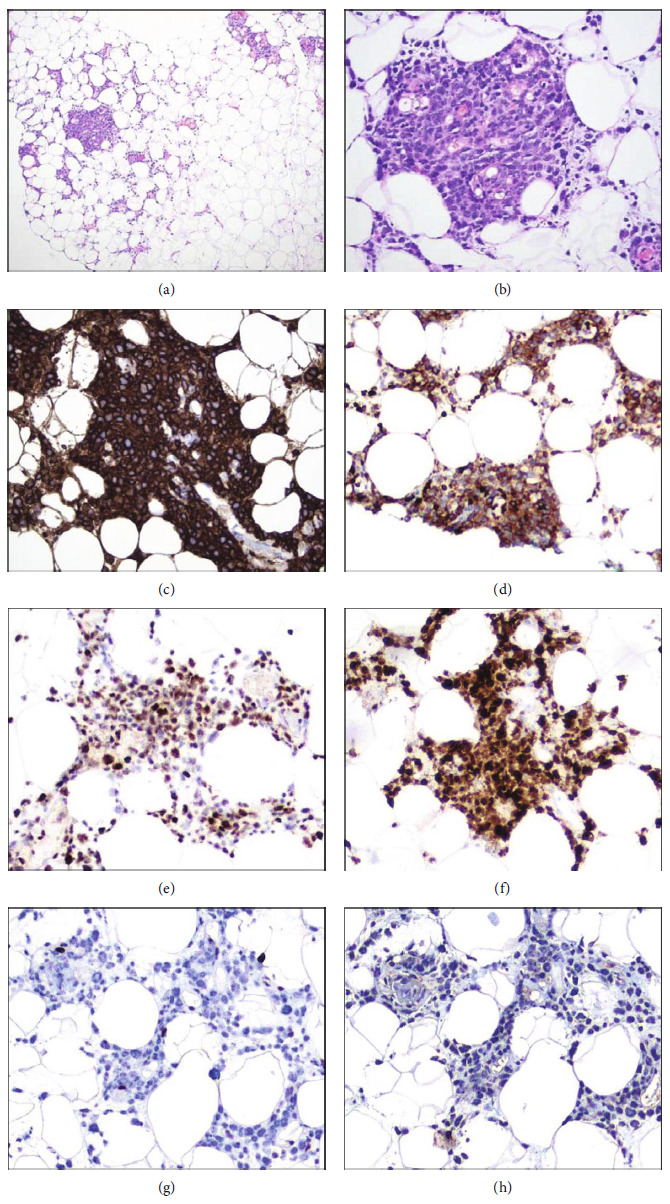 Diffuse Large B-Cell Lymphoma, Not Otherwise Specified (DLBCL NOS) Presenting as Multiple Subcutaneous Nodules: An Unusual Cutaneous Presentation of Systemic Disease.