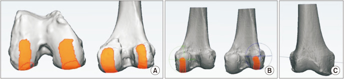 Accuracy of Patient-Specific Instrument for Cylindrical Axis Implementation in Kinematically Aligned Total Knee Arthroplasty.