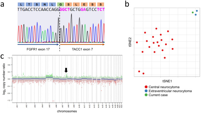 Intraventricular central neurocytoma molecularly defined as extraventricular neurocytoma: a case representing the discrepancy between clinicopathological and molecular classifications.