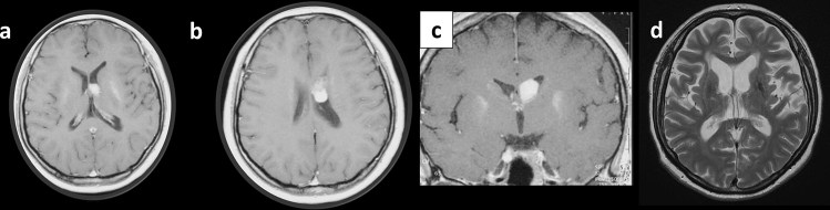 Intraventricular central neurocytoma molecularly defined as extraventricular neurocytoma: a case representing the discrepancy between clinicopathological and molecular classifications.