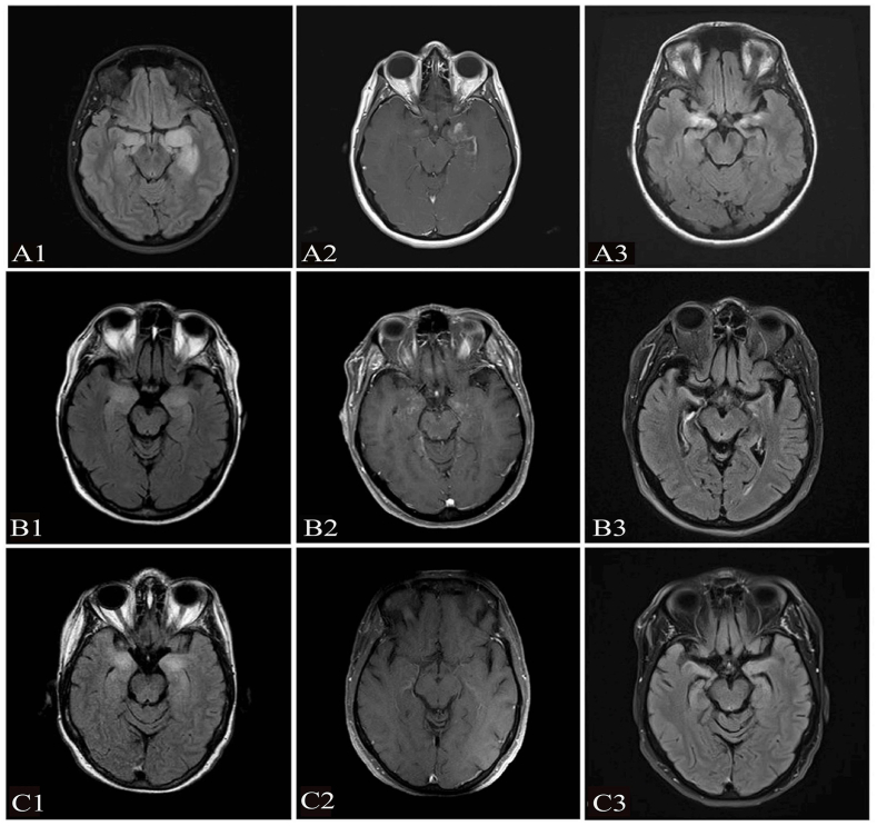 Anti-adenylate kinase 5 encephalitis: Clinical characteristics, diagnosis, and management of this rare entity