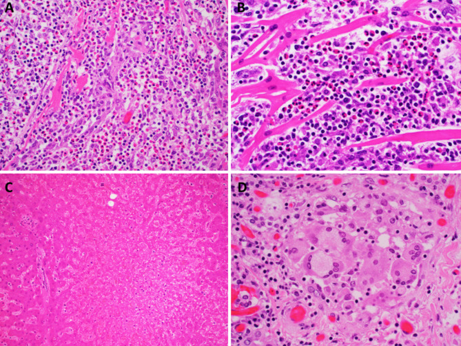 Fatal eosinophilic myocarditis and submassive hepatic necrosis in lamotrigine induced DRESS syndrome.