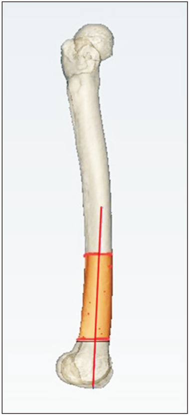 Accuracy of Patient-Specific Instrument for Cylindrical Axis Implementation in Kinematically Aligned Total Knee Arthroplasty.