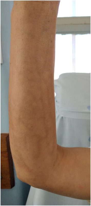 The clinical challenge of refractory eosinophilic fasciitis.