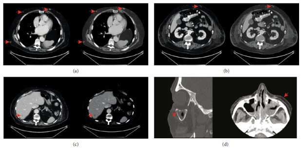 Diffuse Large B-Cell Lymphoma, Not Otherwise Specified (DLBCL NOS) Presenting as Multiple Subcutaneous Nodules: An Unusual Cutaneous Presentation of Systemic Disease.