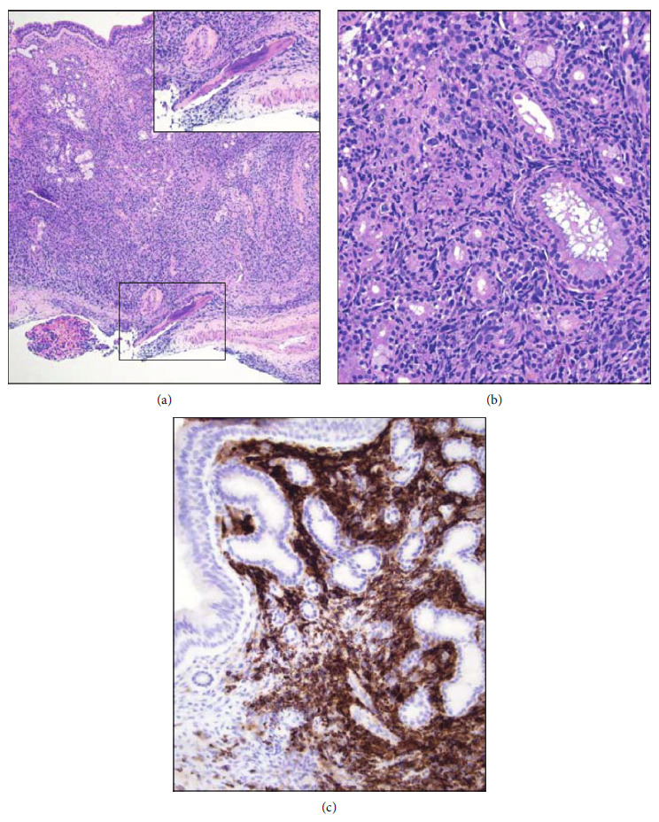 Diffuse Large B-Cell Lymphoma, Not Otherwise Specified (DLBCL NOS) Presenting as Multiple Subcutaneous Nodules: An Unusual Cutaneous Presentation of Systemic Disease.