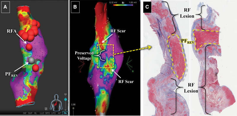 Reversible Pulsed Electrical Fields as an In Vivo Tool to Study Cardiac Electrophysiology: The Advent of Pulsed Field Mapping.