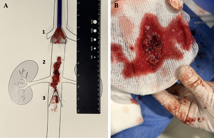 Protrieve sheath utilization for capturing supra-filter thrombus during a retrieval of thrombosed and embedded IVC filter.