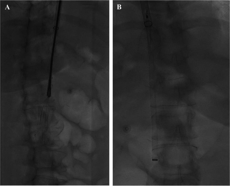 Protrieve sheath utilization for capturing supra-filter thrombus during a retrieval of thrombosed and embedded IVC filter.