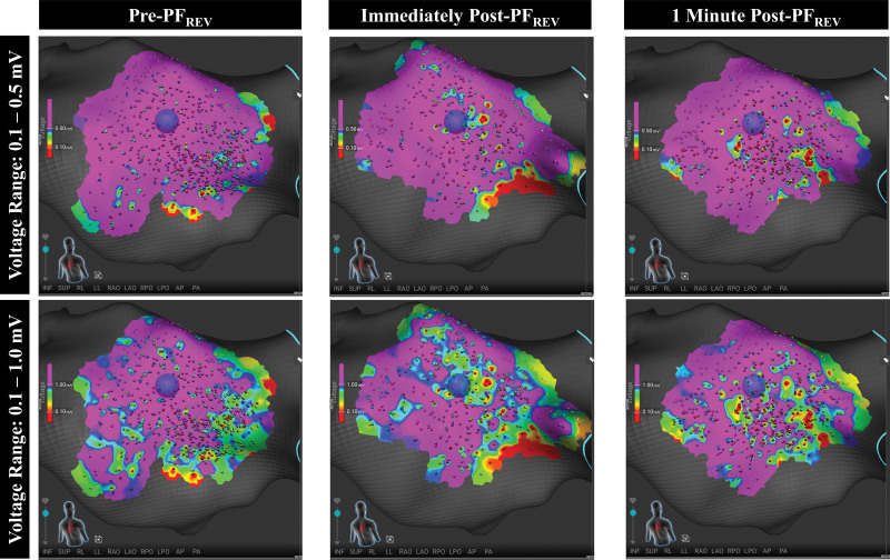 Reversible Pulsed Electrical Fields as an In Vivo Tool to Study Cardiac Electrophysiology: The Advent of Pulsed Field Mapping.