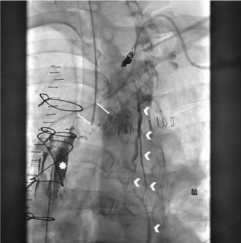 Aggressive Management of a Bilateral Chylothorax Complicating an Orthotopic Heart-Kidney Transplantation.