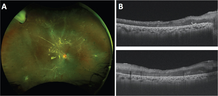 Tractional Retinal Detachment Related to Hemoglobin C Trait Retinopathy: A Case Report.