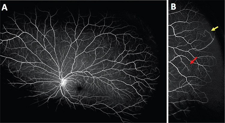 Tractional Retinal Detachment Related to Hemoglobin C Trait Retinopathy: A Case Report.