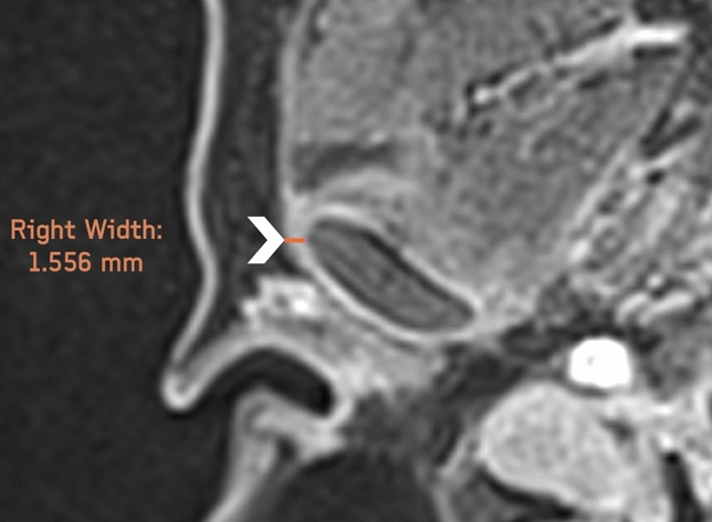 Temporomandibular joint involvement in patients with Juvenile Idiopathic Arthritis: comparison of ultrasonography and magnetic resonance imaging in assessing the periarticular space width.