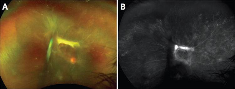 Tractional Retinal Detachment Related to Hemoglobin C Trait Retinopathy: A Case Report.