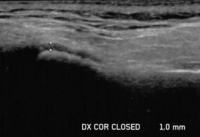 Temporomandibular joint involvement in patients with Juvenile Idiopathic Arthritis: comparison of ultrasonography and magnetic resonance imaging in assessing the periarticular space width.