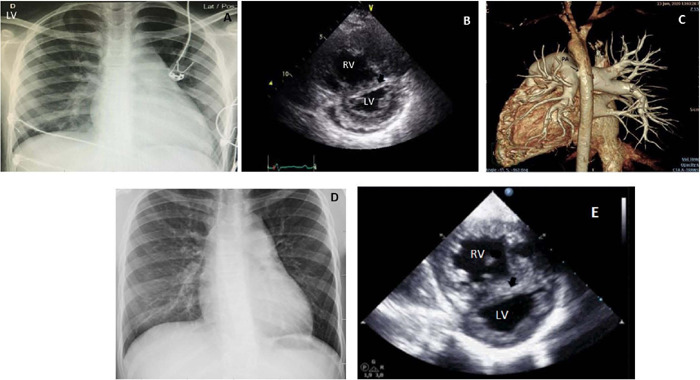 Reversed Potts Shunt as a Palliative Option for EndStage Idiopathic Pulmonary Arterial Hypertension in Childhood.