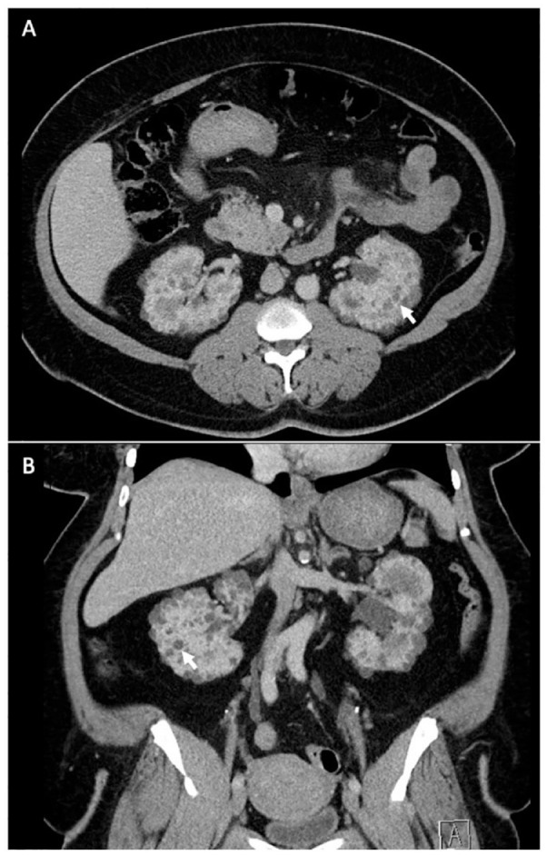 Atypical ADPKD Due to a <i>DNAJB11</i> Pathogenic Variant: An Educational Case Report.