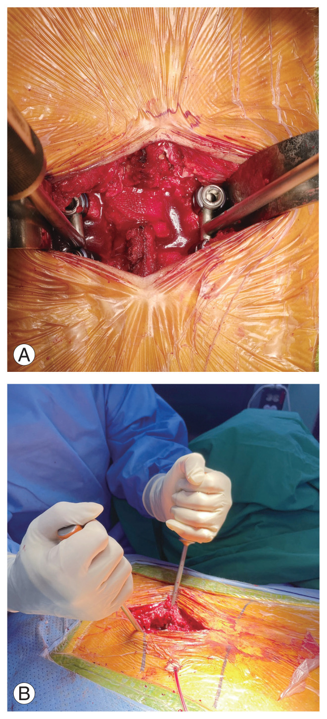 A New Technique for Lumbar Spondylolisthesis Reduction Using T-Shaped Tools.