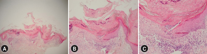 Porokeratosis ptychotropica: a case report.