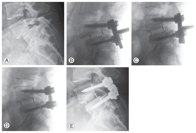 A New Technique for Lumbar Spondylolisthesis Reduction Using T-Shaped Tools.