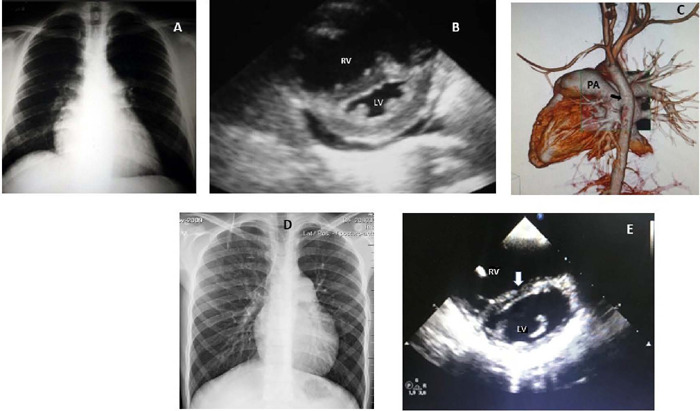 Reversed Potts Shunt as a Palliative Option for EndStage Idiopathic Pulmonary Arterial Hypertension in Childhood.