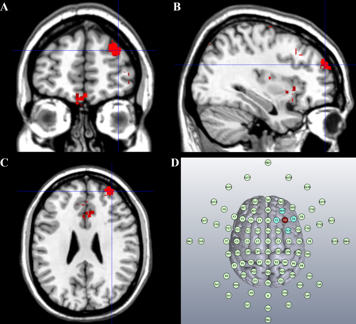 High-definition transcranial direct current stimulation over the right dorsolateral prefrontal cortex reduces risk-taking.