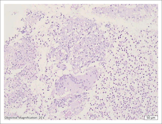 Probable endometrial tuberculosis in a patient with rhupus.