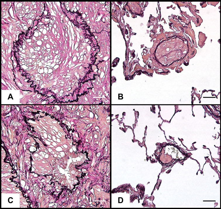 Smooth muscle hamartoma of the lungs in a Wistar Hannover rat.