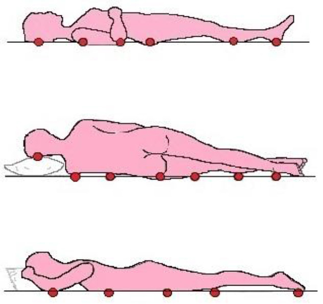 Design and Implementation of a Novel Double-Layered Wavy Mattress for the Prevention and Recovery of Pressure Ulcers: A Feasibility Study.