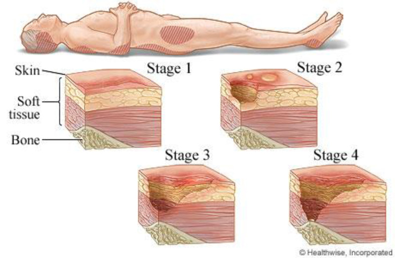 Design and Implementation of a Novel Double-Layered Wavy Mattress for the Prevention and Recovery of Pressure Ulcers: A Feasibility Study.