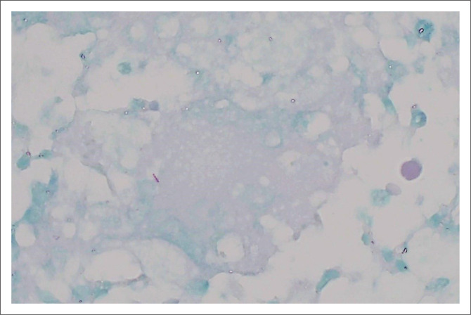 Probable endometrial tuberculosis in a patient with rhupus.